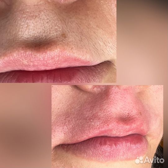 Электроэпиляция