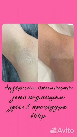 Лазерная эпиляция