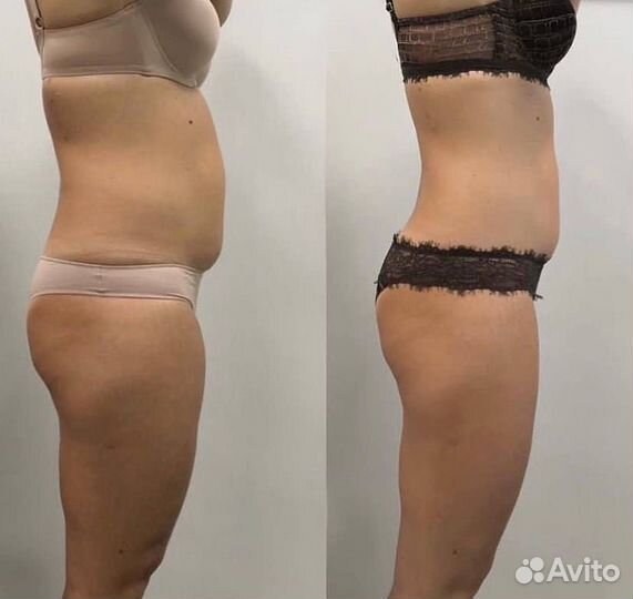 LPG массаж, вибромассаж, кавитация, биотоки