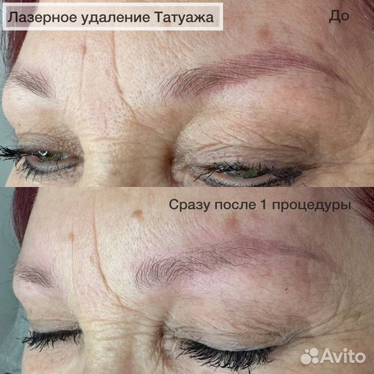 Удаление татуажа бровей, тату