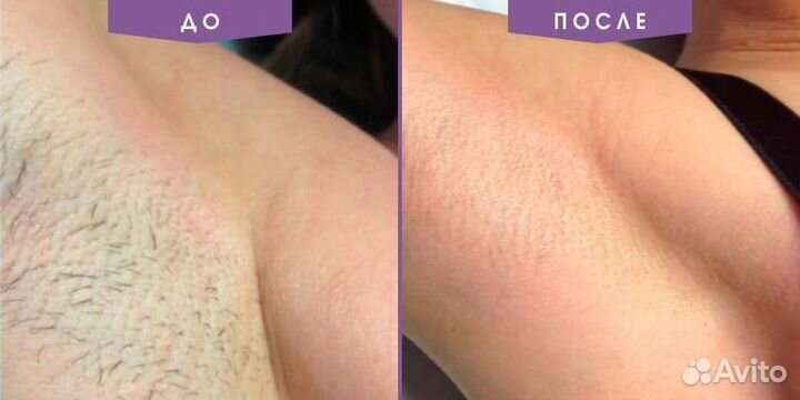 Электроэпиляция: ягодицы