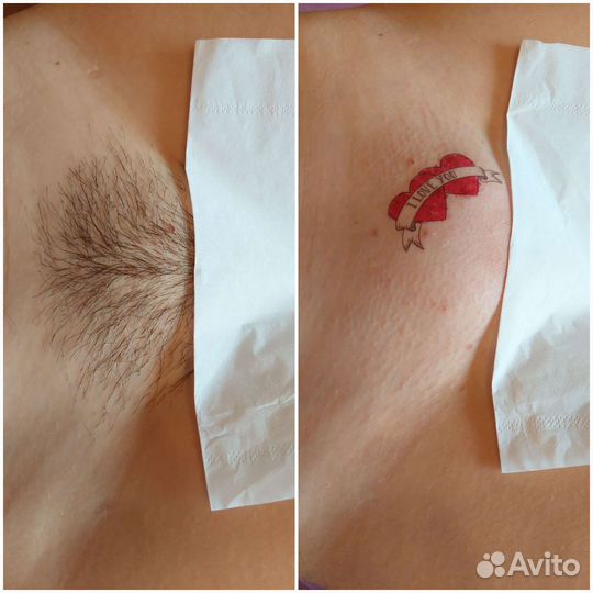 Шугаринг депиляция