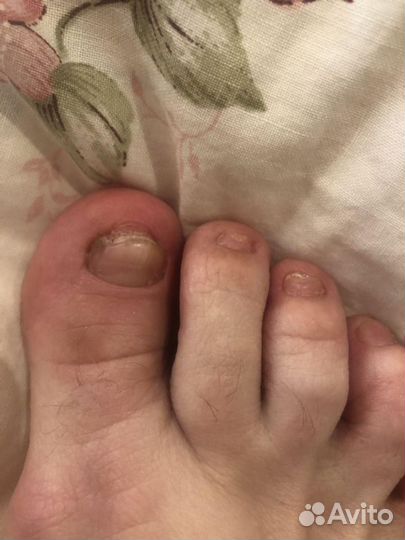 Педикюр подолог