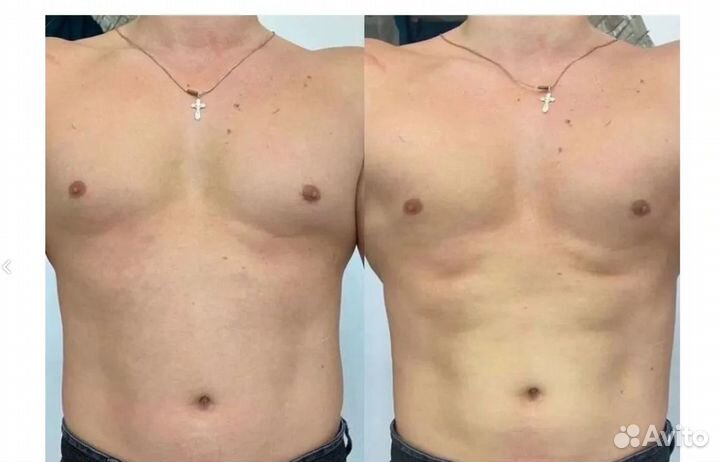 Плоский живот - размер за 1 процедуру Рост на Дону