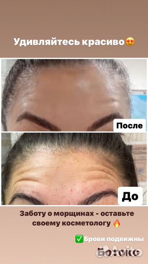 Ботокс