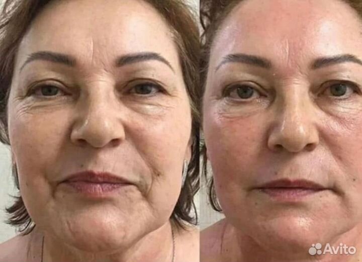 СМАС лифтинг лица и тела