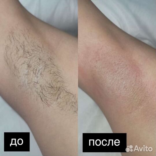 Депиляция
