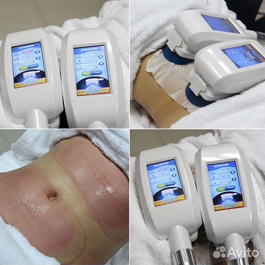 Модель на криолиполиз