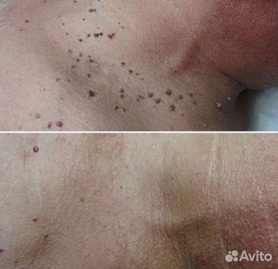 Удаление папиллом