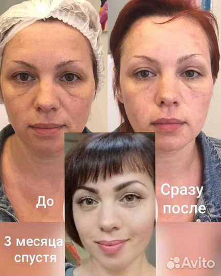 Смас лифтинг