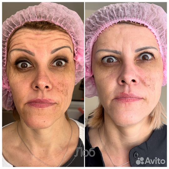 Ботулинотерапия, ботулотоксин, диспорт, релатокс