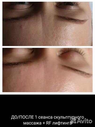 Скульптурно-буккальный массаж лица,рф,чистка лица