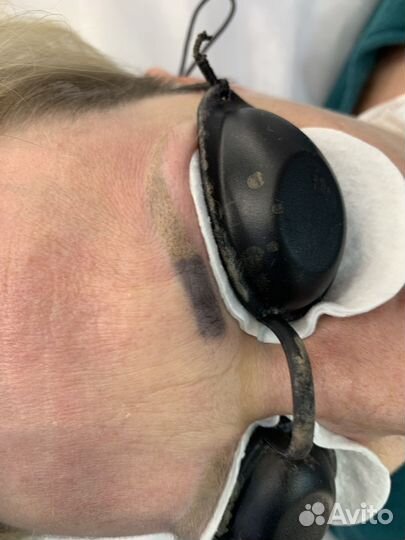 Лазерное удаление татуажа