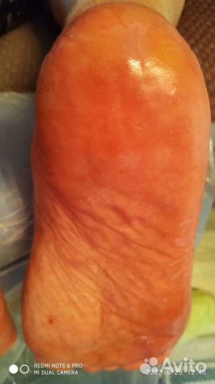 Лечебный педикюр