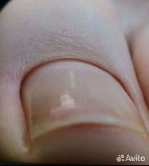 Педикюр, титановая нить, вросшие ногти, онихолизис