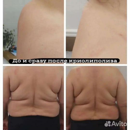 Криолиполиз