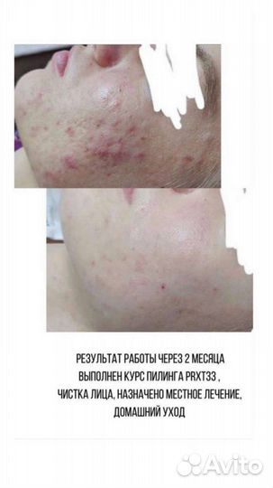 Шугаринг, косметолог