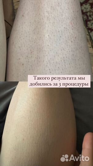 Elos эпиляция
