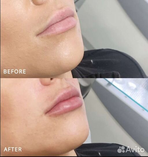 Косметолог увеличение губ