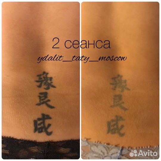 Удаление тату,Татуаж,пилинг,удалить татуировку