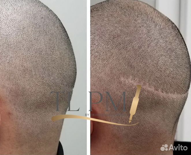 Трихопигментацию