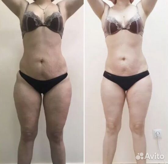 Похудеете аппаратный массаж Скетч