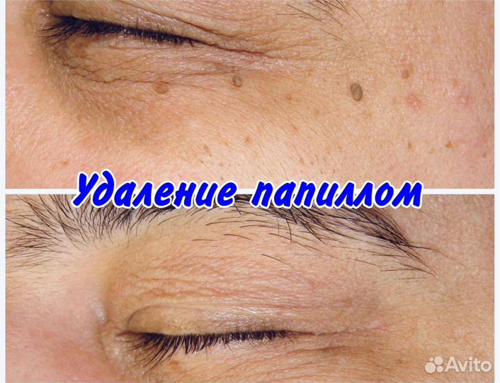 Удaление папиллoм, бородавок, новоoбрaзовaний