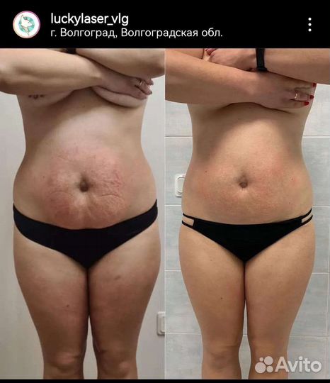 Коррекция фигуры, аппаратные процедуры