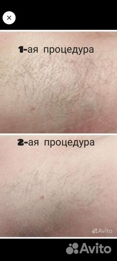Электроэпиляция