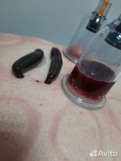 Купон на сеанс гирудотерапии