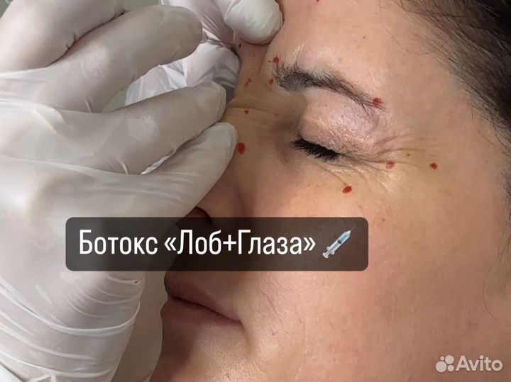 Ботокс Full face