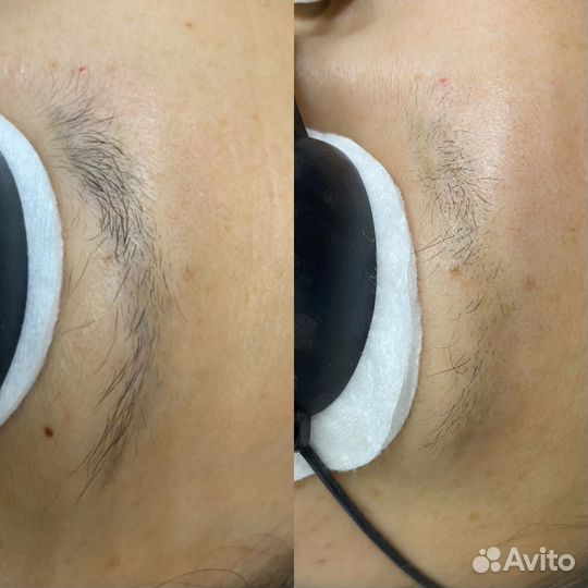 Удаление татуажа и тату лазером