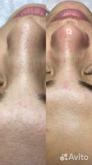 Чистка лица гостиный двор