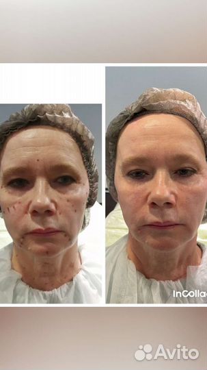 Карбокситерапия (газовые уколы)