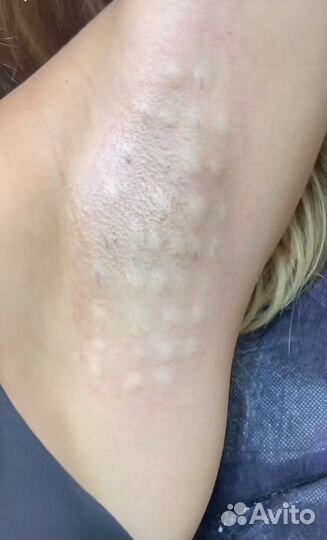 Гипергидроз подмышек,ладоней,ступней