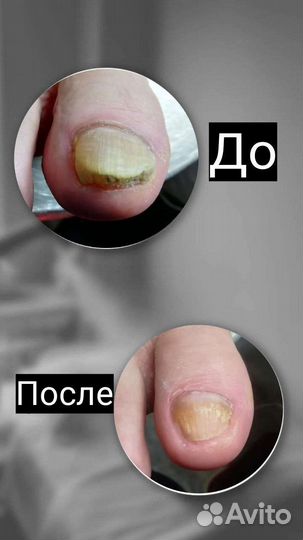 Лечебный педикюр