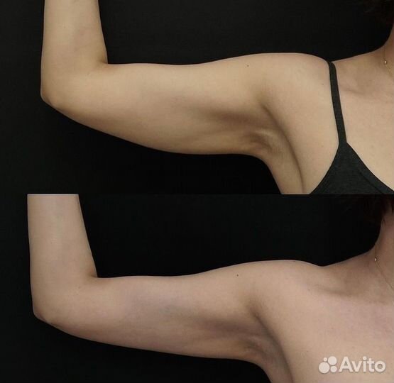 Косметолог - Кавитация, настоящий жиротоп