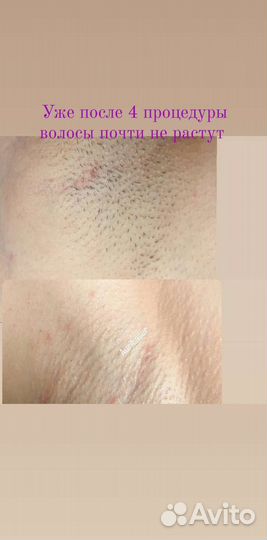 Лазерная эпиляция