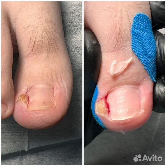 Медицинский педикюр. Подолог