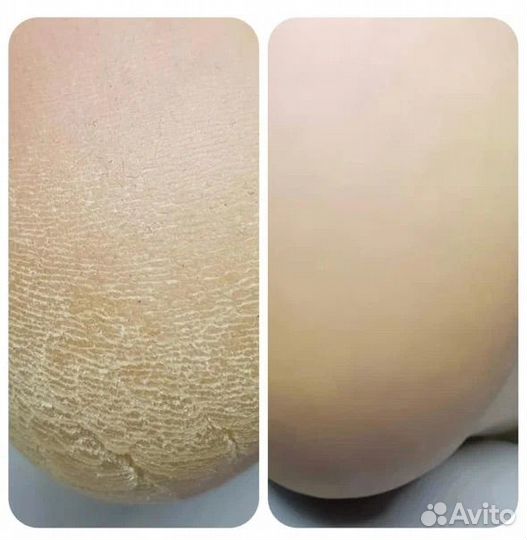 Педикюр, смарт педикюр