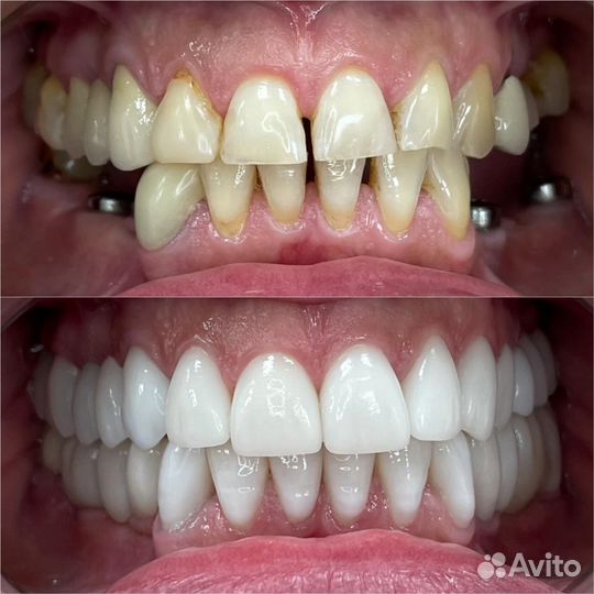 Виниры на зубы