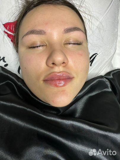 Контурная пластика губ