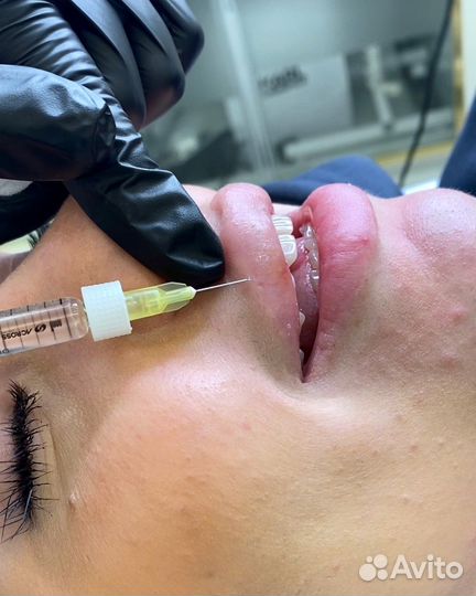 Увеличения губ/ косметолог