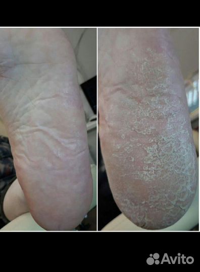 Медицинский педикюр.Подолог. Эстет педикюр