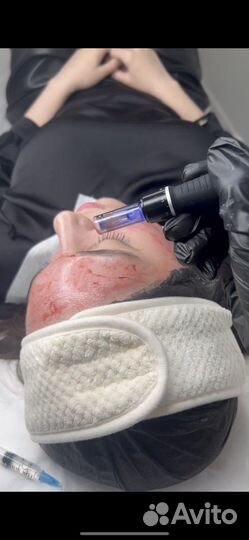 Аппаратная мезотерапия