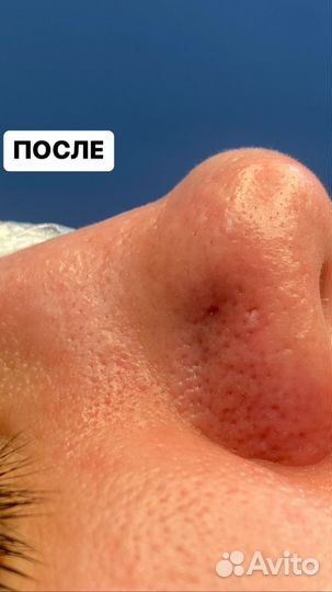 Чистка лица