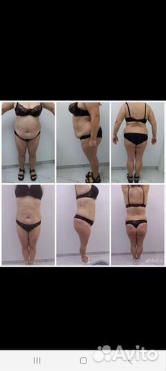 Криолиполиз, кавитация, прессотерапия, LPG, емс