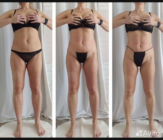 Антицеллюлитный массаж, коррекция фигуры