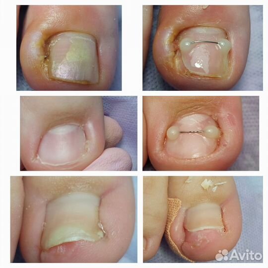 Медицинский педикюр подолог