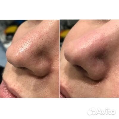 Косметолог чистка лица